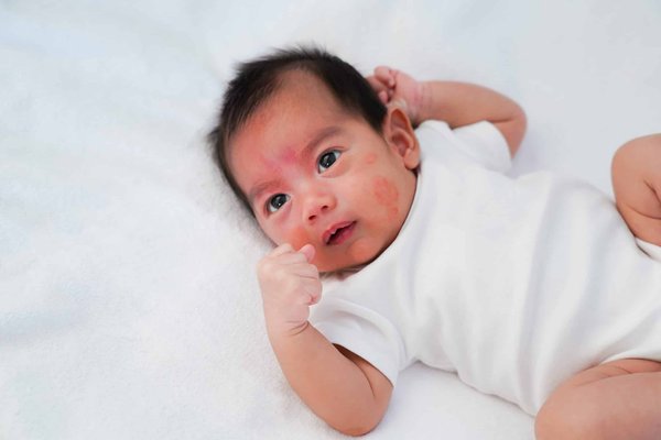 Bio et efficace : La solution pour l'eczéma atopique de votre bébé